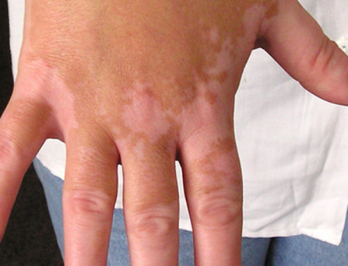 Un Tunisien trouve un traitement contre la maladie du Vitiligo